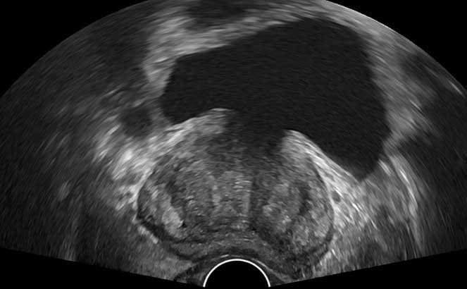 cancer de prostata ultrassonografia nutriția în tratamentul helmintiazei