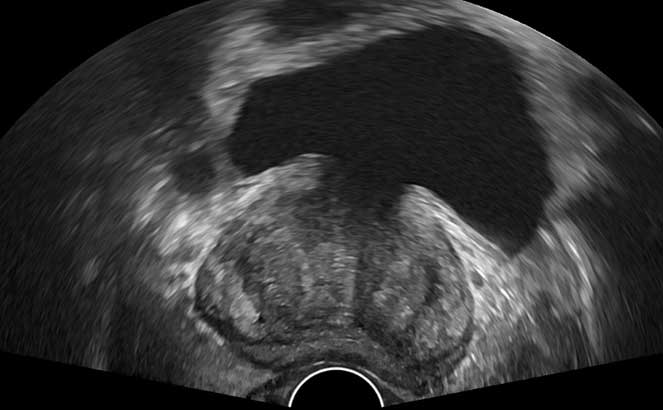 Fotos de ecografia prostática (da próstata)