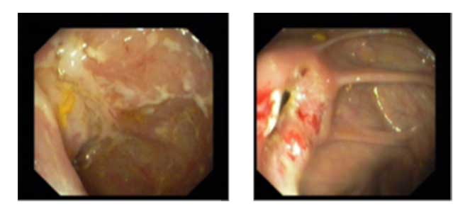 Fotos, Imagens de doença de Crohn