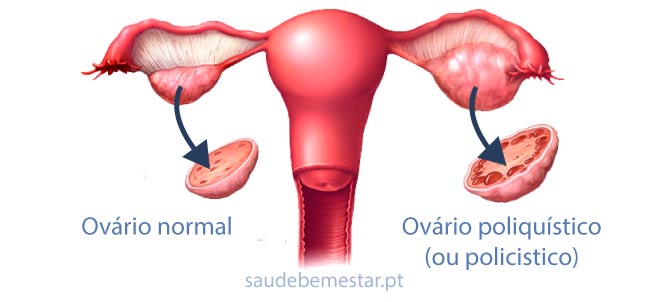 COMO SABER SE A SUA MENSTRUAÇÃO ESTA DESREGULADA ? Menstruação, Ovários policísticos, Tratamentos naturais