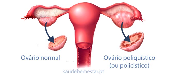 Fotos de ovário policistico