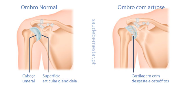 Artrose no ombro