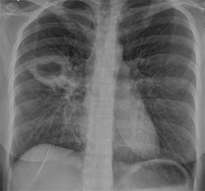 Raio X (RX) de pulmões com tubercolose