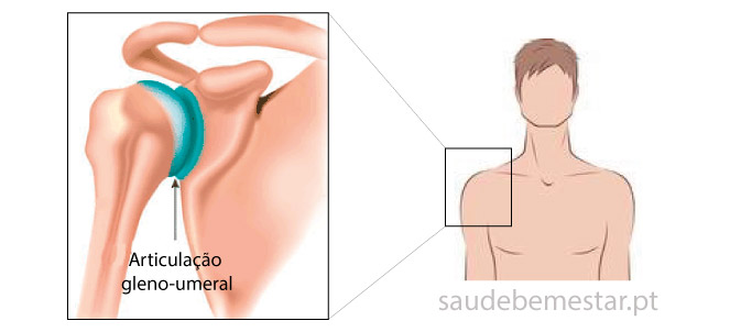 Síndrome do ombro congelado