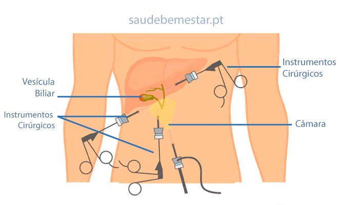 Colecistectomia fotos, imagens
