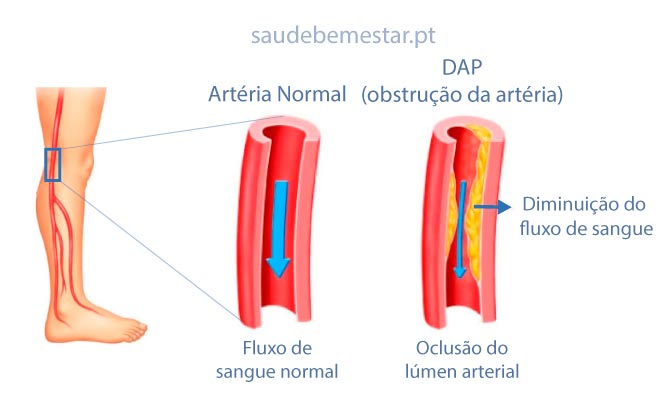 Fotos de doença arterial periférica