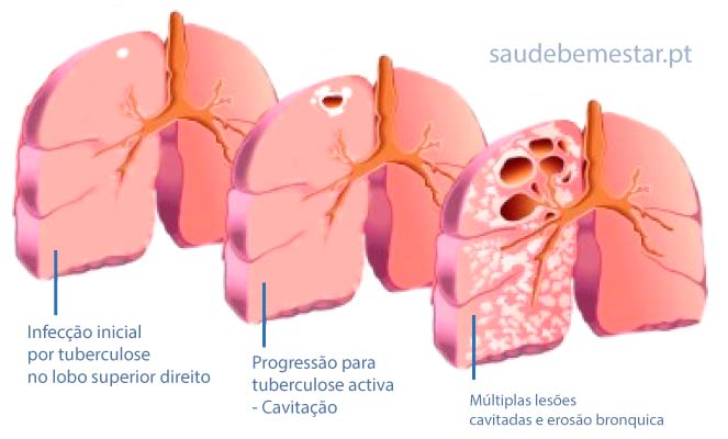 Tuberculose