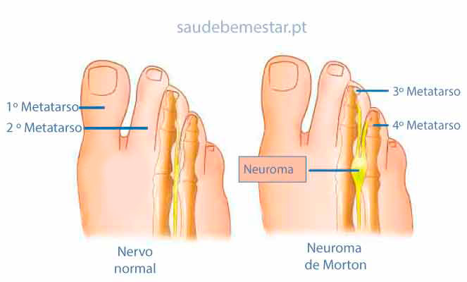 Neuroma de morton causas