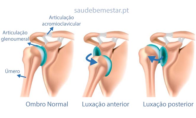 Luxação do ombro