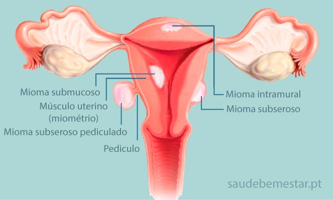Cirurgia de mioma uterino