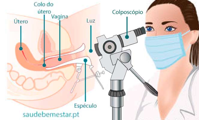 Colposcopia