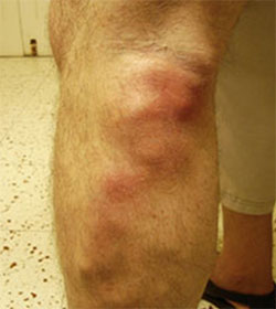 Trombose venosa superficial na perna