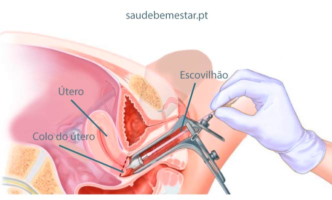 Papanicolau