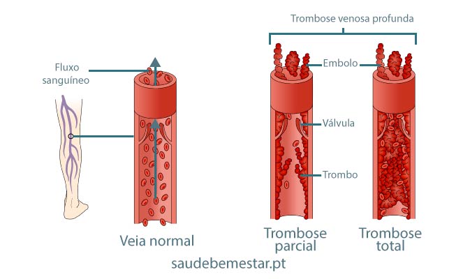 Trombose venosa profunda