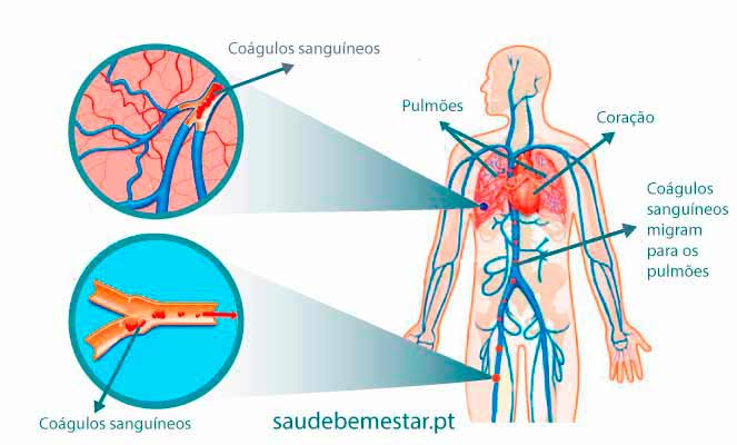 Embolia pulmonar