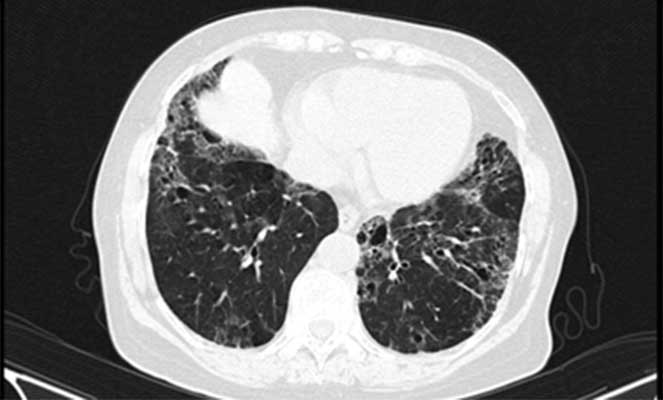 Fibrose pulmonar