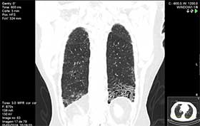 Fotos de Fibrose Pulmonar