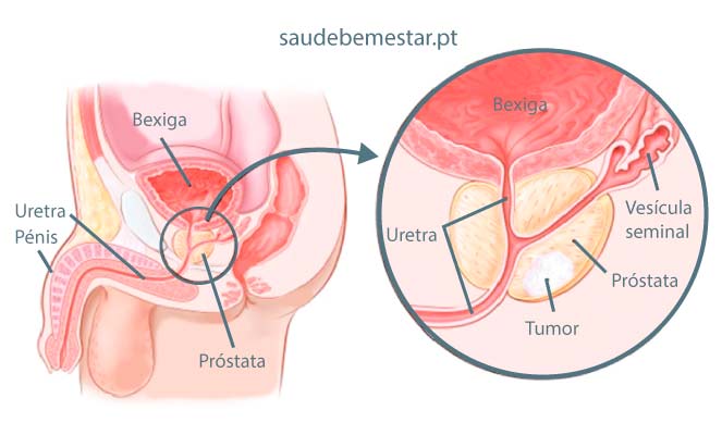 cancer prostata tratamento injecao