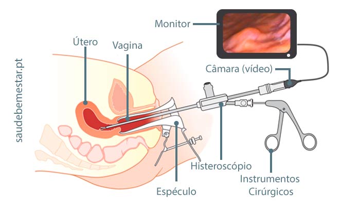 Fotos de histeroscopia cirúrgica