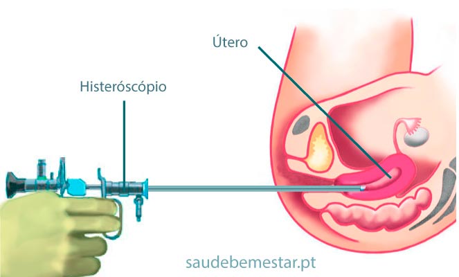 Histeroscopia