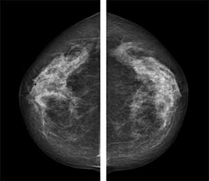 Imagem de mamografia