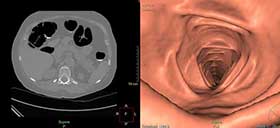 TC na colonoscopia virtual