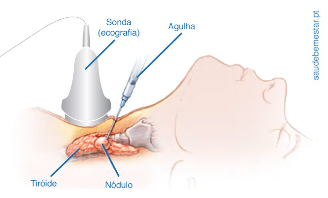 Biópsia da tiróide