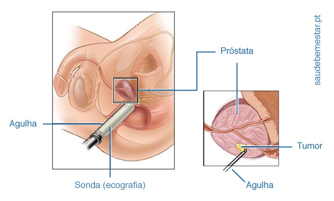 eco de prostata transretal