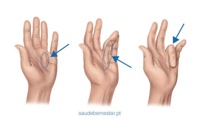 Contratura ou mal de Dupuytren