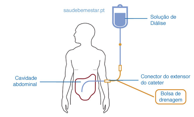 Fotos de dialise peritoneal