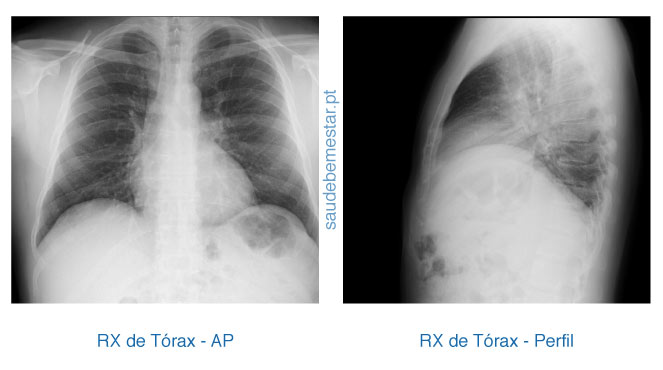 Fotos de RX do tórax