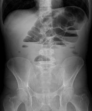 RX abdominal