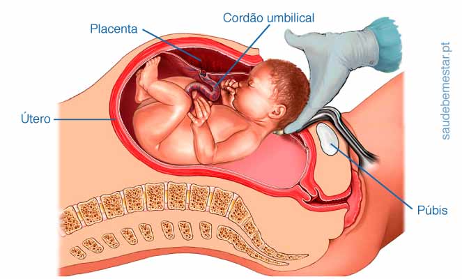 Cesariana - indicações, riscos, como é feita, recuperação após parto