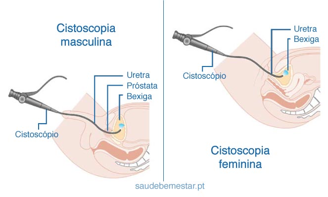 Cistoscopia