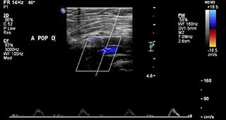 Ecografia Dopller