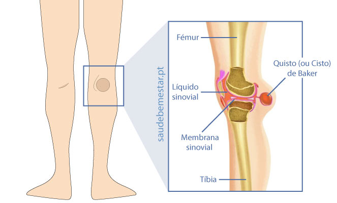 Quisto de Baker ou Cisto de Baker