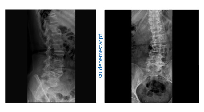 Fotos de raio x da coluna