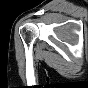 TAC articular