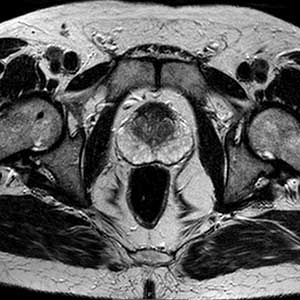 Ressonância Magnética (RM) da próstata