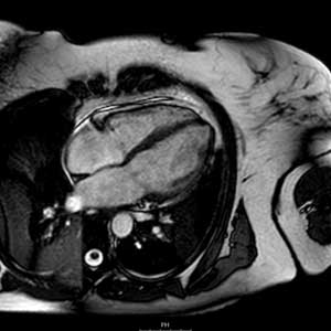 Ressonância Magnética (RM) cardíaca (do coração)