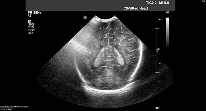 Fotos de ecografia transfontanelar