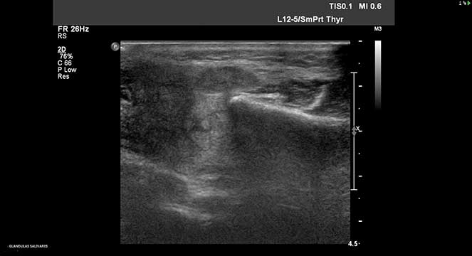 Fotos de ecografia glândulas salivares