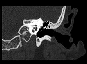 Tomografia Computorizada do ouvido