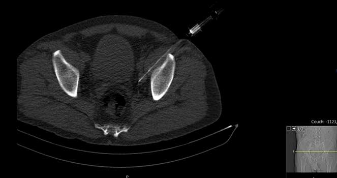 Radiologia de Intervenção