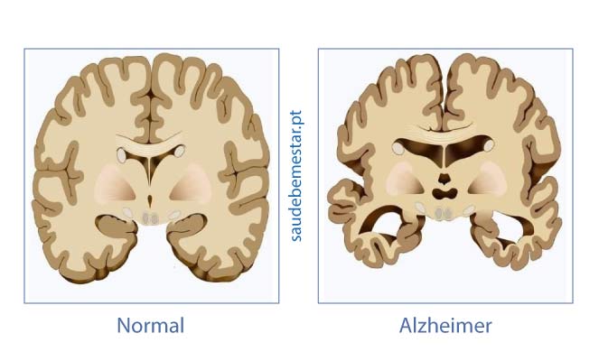 Doença ou Mal de Alzheimer