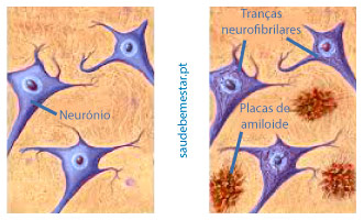 Placas na doença de Alzheimer