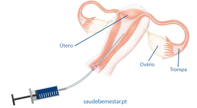 Inseminação artificial