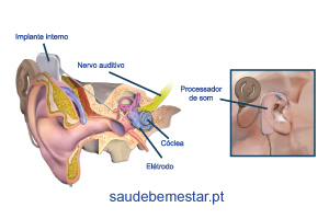 Implante Coclear