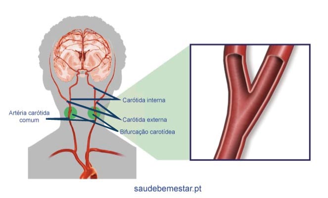 Estenose da carótida