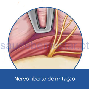 Nervo libertado